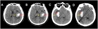 Morphological characteristics of CT blend sign predict hematoma expansion and outcomes in intracerebral hemorrhage in elderly patients